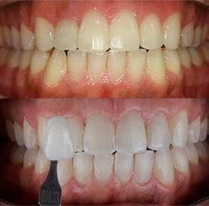 Clareamento Dental Caseiro: Sorriso Mais Branco! 😁✨